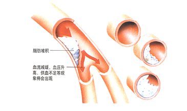 高血脂症