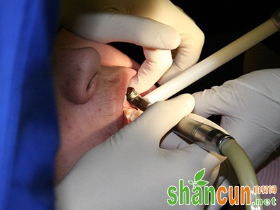 牙周炎可用牙髓干细胞治疗！