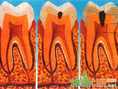 唾液成分和流速可影响龋齿发生