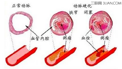 糖尿病就是心血管疾病 山村