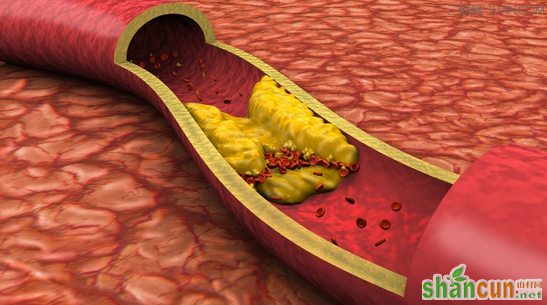 远离动脉硬化症的妙招     山村