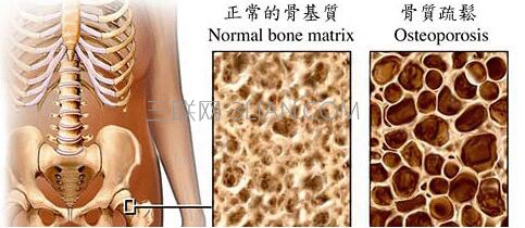 骨质疏松有多么可怕     山村