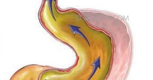 什么原因会引起胆汁反流性胃炎     山村