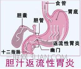 胆汁反流性胃炎生活要注意些什么     山村