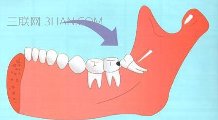 长智齿引起牙龈肿痛怎么办   山村