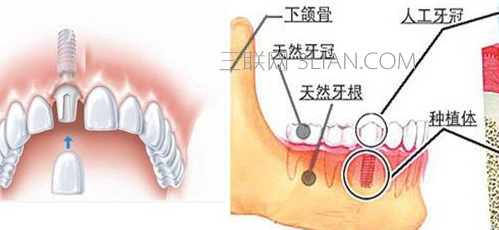 种植牙的利与弊    山村