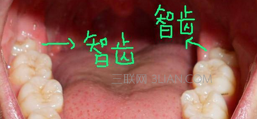 智齿有必要拔吗    山村