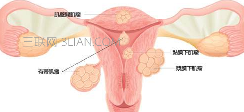 良性子宫肌瘤有什么症状     山村