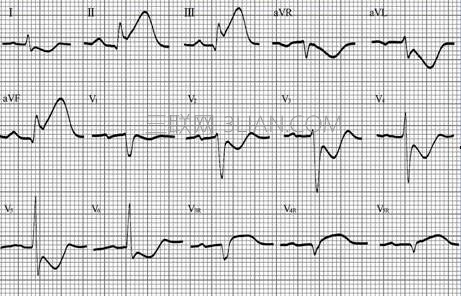 心电图怎么看   山村