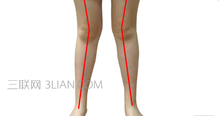 X型腿不直怎么办     山村