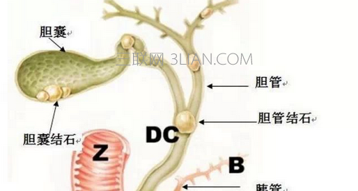哪些人容易胆结石     山村