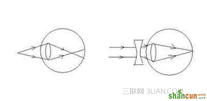  假性近视怎么恢复 山村