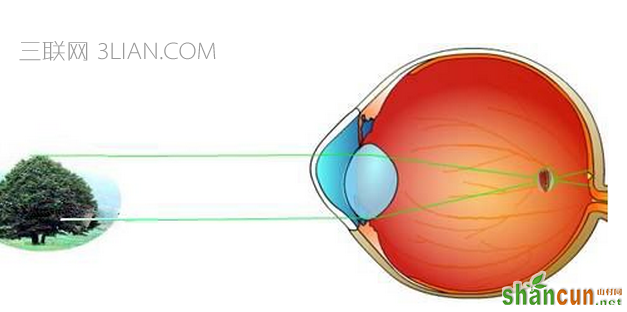  近视是怎样形成的 山村