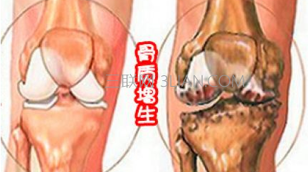  如何治疗骨质增生     山村