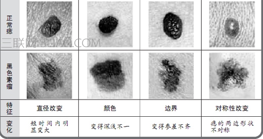 黑色素瘤和痣的区别   山村