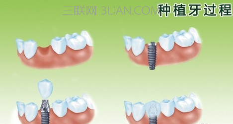 种植牙后注意事项    山村