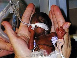 泰勒是世界上出生时体型最小的婴儿