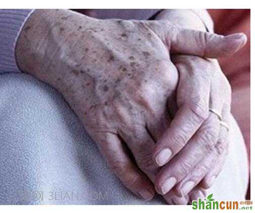 女人一般几岁开始长老年斑 如何保养肌肤预防老年斑 山村