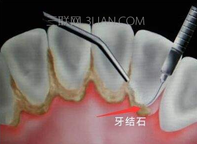 牙结石会自动脱落吗？自己在家怎么去除牙结石   山村