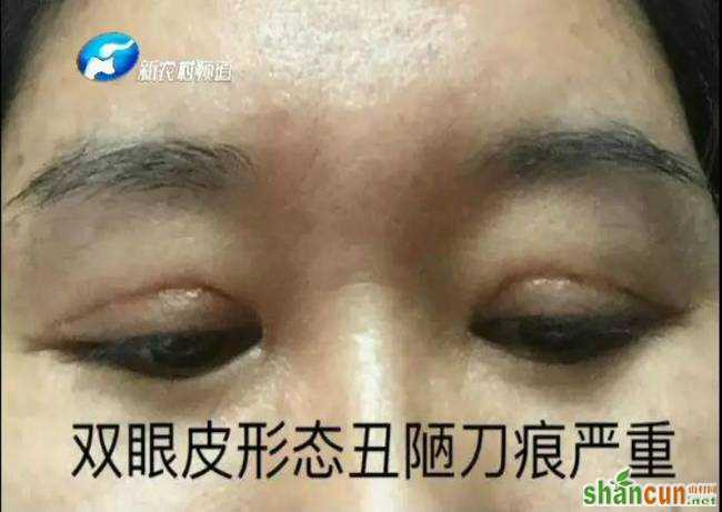 整形美容有风险 做了双眼皮眼睛闭不上 责任谁来担？