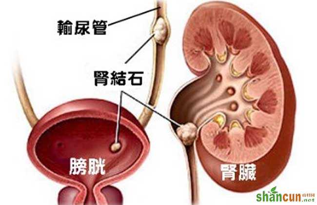 肾结石是怎么形成的